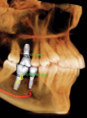 simulated implant placement