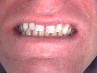 porcelain veneer